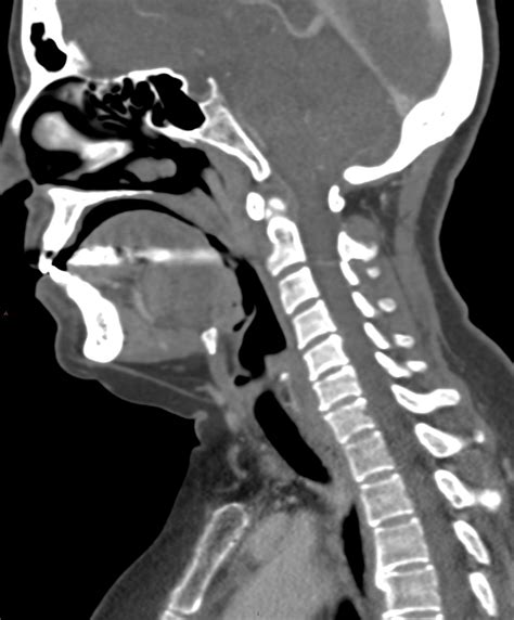 soft tissue scan for neck